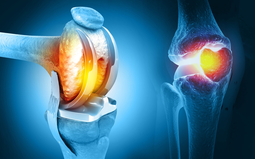 joint replacement